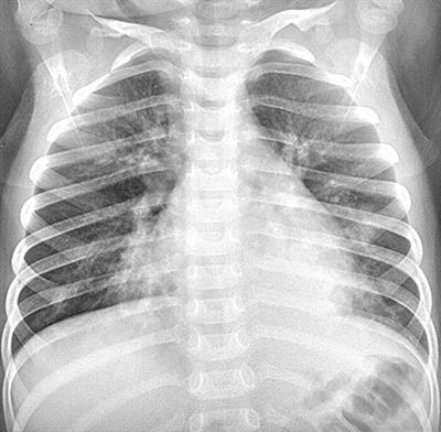 Severe Adenovirus Pneumonia Requiring Extracorporeal Membrane Oxygenation Support in Immunocompetent Children